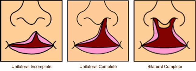 Cleft Lip and Palate